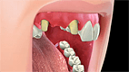 Dental Bridge- Family Dentistry of Buckeye