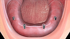 Implant for Denture