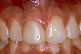 Before - Porcelain Crowns